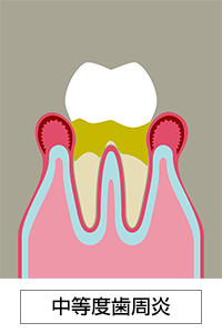 中等度歯周炎